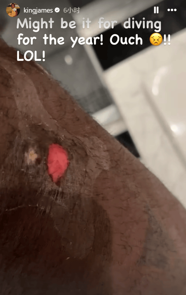 詹姆斯腿部伤势或成湖人季后赛关键变数